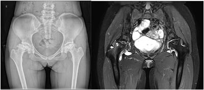 Anti-RNP Antibody: A Potential Novel Predictor for Osteonecrosis in Systemic Lupus Erythematosus